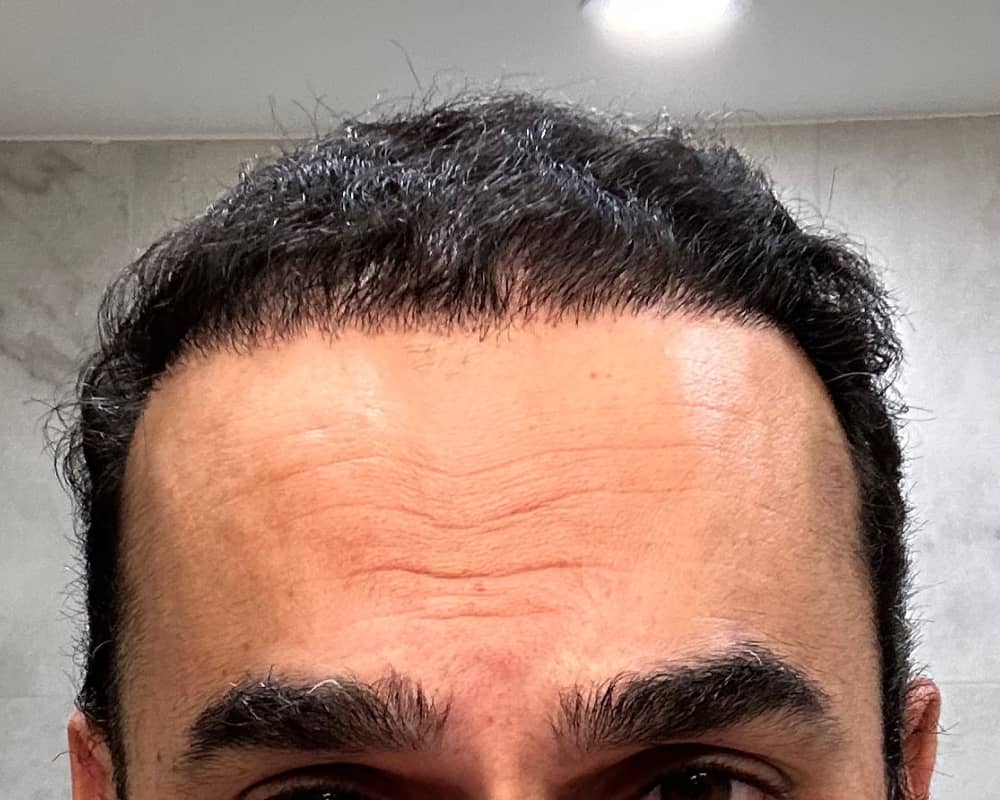 Art's hairline after hair transplant showing restored hair