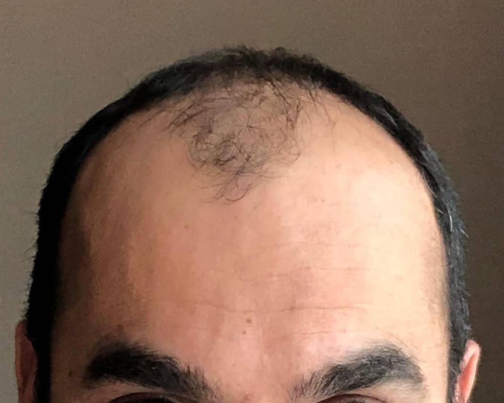 Art's hairline before hair transplant showing significant hair loss