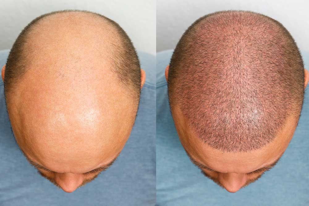 Hair transplant before and after comparison showing significant hair restoration results