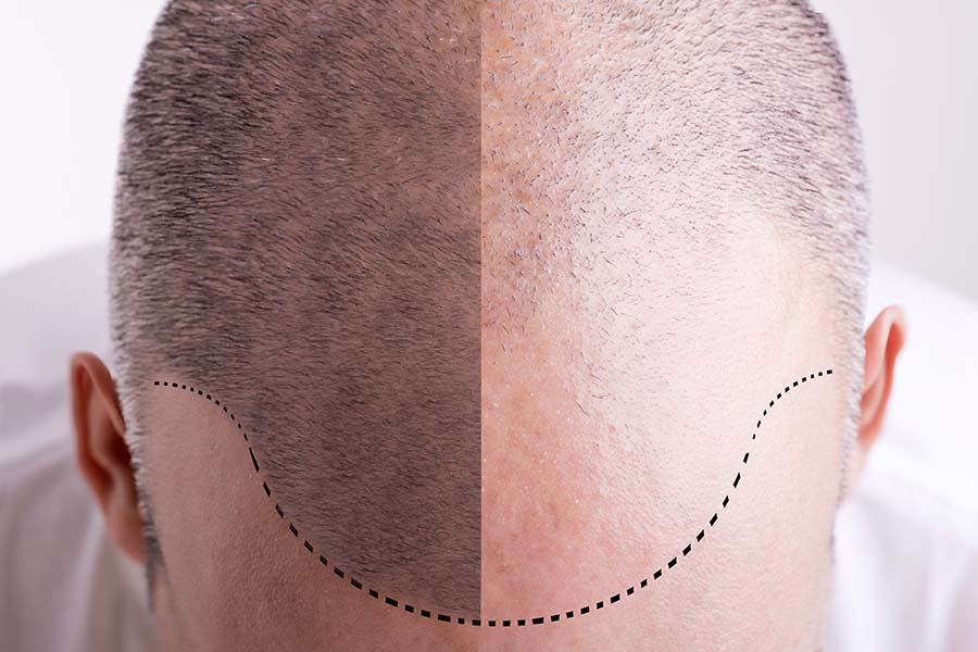 Hair transplant donor area illustration showing the back of the head with marked extraction zone