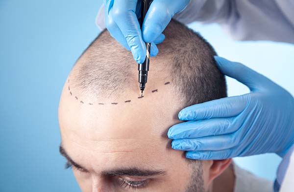 Hair transplant procedure showing a surgeon marking the hairline on a patient's scalp